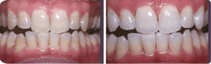 Whitening