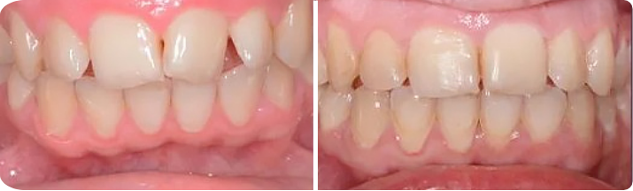 Invisalign (Completed In 2.3 Years)