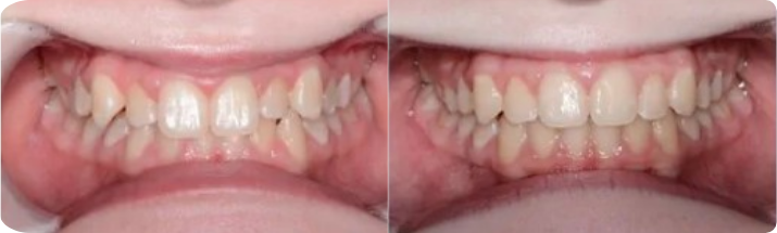 Invisalign (Completed In 3.5 Months)