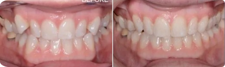 Invisalign (Completed In 8 Months)