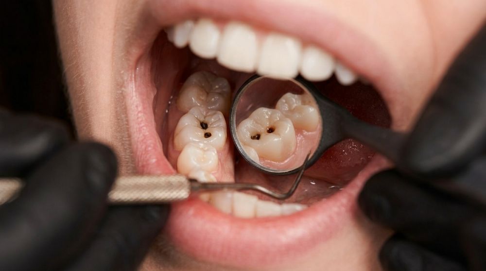 That Small Black Point on Your Tooth: Causes, Treatments, and When to Act