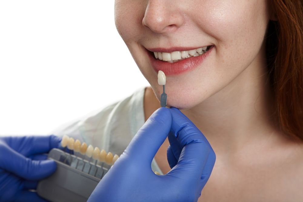 Dental Veneers