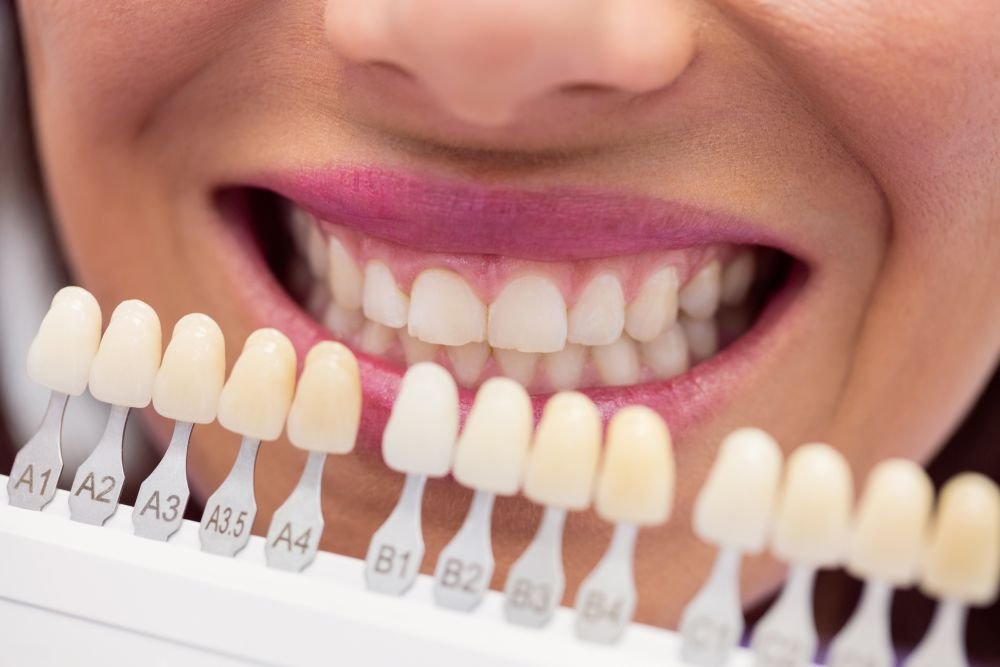 Veneer Cost in Ontario: A 2026 Price Guide