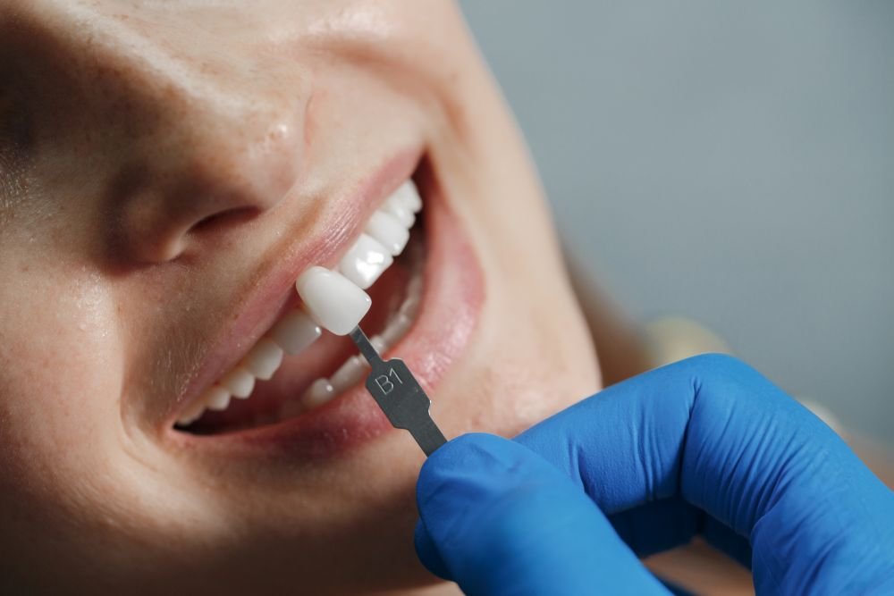 How Much Does a Single Tooth Implant Cost in Canada?
