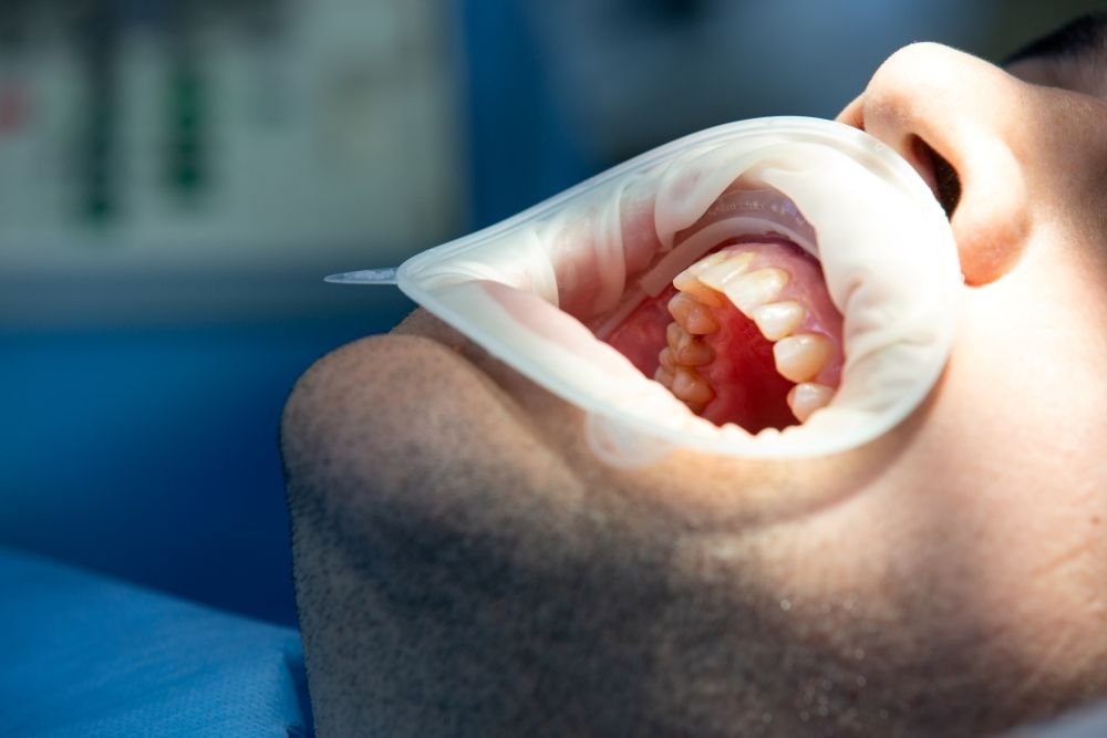 Treatment Options for Receding Gums
